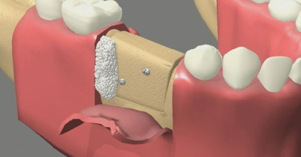 Bone Graft: Purpose, Procedure, and Risks | Rancho Mirage Bone Graft: Purpose, Procedure, and Risks | Rancho Mirage