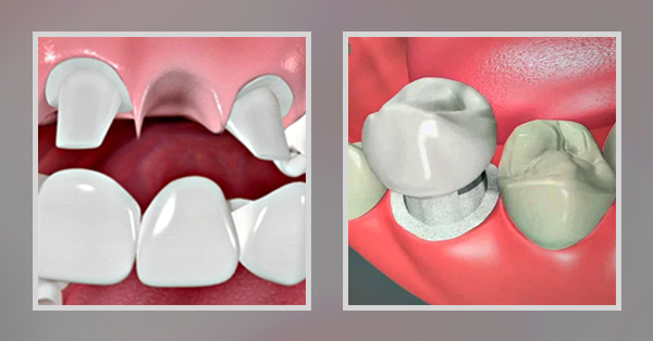 Dental Bridges and Crowns Palm Desert?