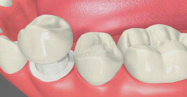 dental bridges and crowns Palm Desert dental bridges and crowns Palm Desert