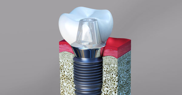 Dental Implants Palm Desert Dental Implants Palm Desert