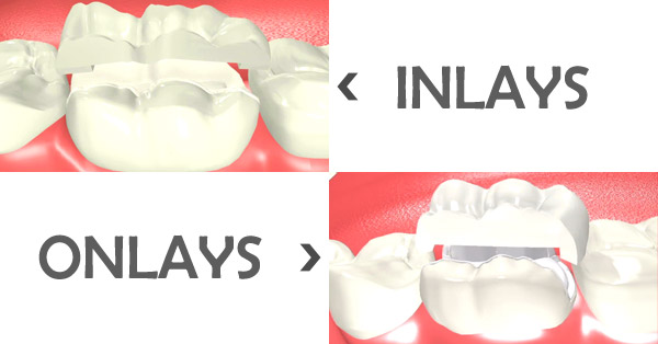 Dental Inlay & Onlay : What's The Difference Dental Inlay & Onlay : What's The Difference