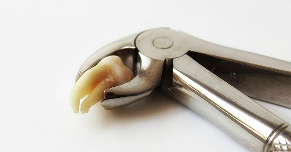 Difference B/W Root Canal & Tooth Extraction Difference B/W Root Canal & Tooth Extraction