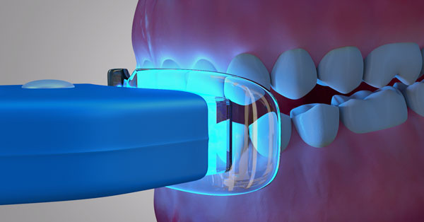 Teeth Whitening Palm Desert Teeth Whitening Palm Desert