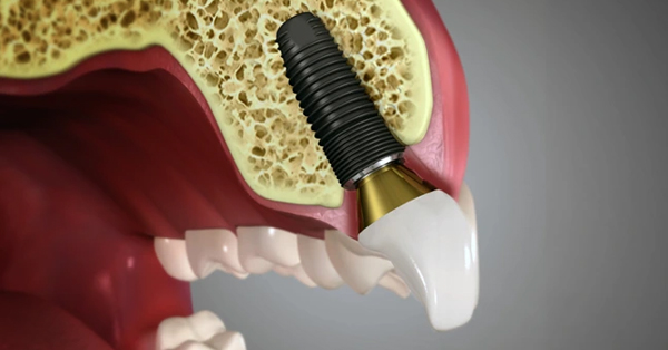 Why are dental implants necessary? Why are dental implants necessary?