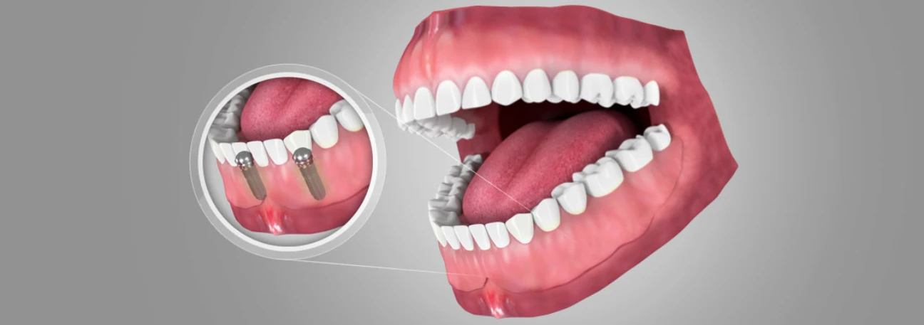 Implant supported snap-on denture