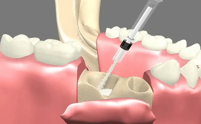 Bone Graft Bone Graft Rancho Mirage, Palm Desert, Palm Spring, Coachella Valley, Cathedral City, La Quinta, Desert Hot Springs, Yucca Valley, Indian Wells