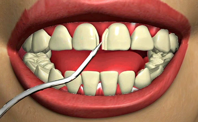 Dental Veneers Rancho Mirage, Palm Desert, Palm Spring, Coachella Valley, Cathedral City, La Quinta, Desert Hot Springs, Yucca Valley, Indian Wells