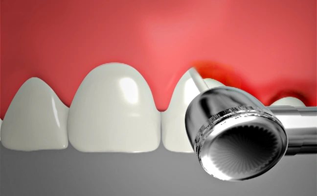 Dental Veneers Rancho Mirage, Palm Desert, Palm Spring, Coachella Valley, Cathedral City, La Quinta, Desert Hot Springs, Yucca Valley, Indian Wells