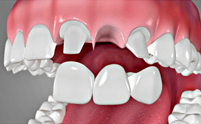 Dental Bridges Dental Bridges Rancho Mirage, Palm Desert, Palm Spring, Coachella Valley, Cathedral City, La Quinta, Desert Hot Springs, Yucca Valley, Indian Wells