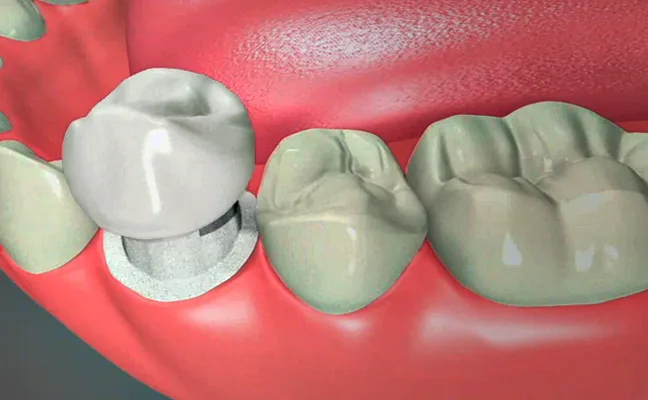 Dental Crowns in Rancho Mirage