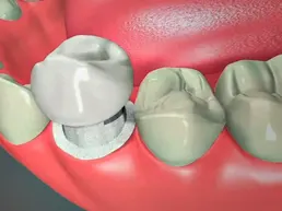 Dental Crowns Dental Crowns Rancho Mirage, Palm Desert, Palm Spring, Coachella Valley, Cathedral City, La Quinta, Desert Hot Springs, Yucca Valley, Indian Wells