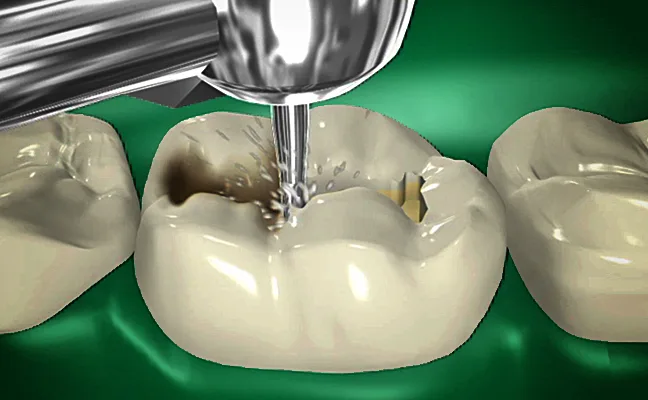 Dental Fillings Rancho Mirage, Dental Fillings Palm Desert, Dental Fillings Palm Spring, Dental Fillings Coachella Valley, Dental Fillings Cathedral City, Dental Fillings La Quinta, Dental Fillings Desert Hot Springs, Dental Fillings Yucca Valley, Dental Fillings Indian Wells