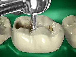 Dental Filling Dental Fillings Rancho Mirage, Palm Desert, Palm Spring, Coachella Valley, Cathedral City, La Quinta, Desert Hot Springs, Yucca Valley, Indian Wells