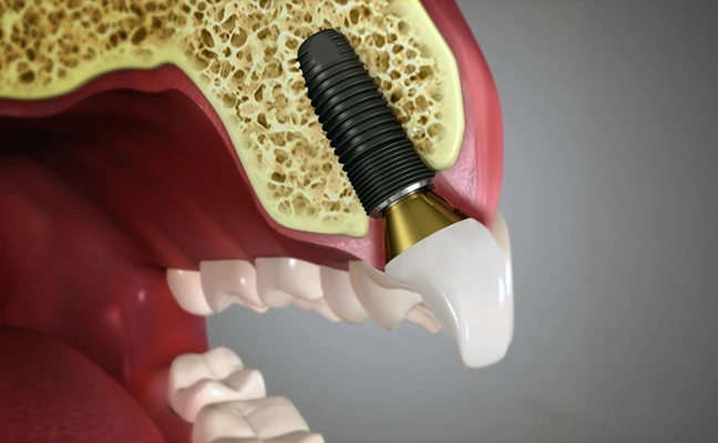 Dental Implants Rancho Mirage, Palm Desert, Palm Spring, Coachella Valley, Cathedral City, La Quinta, Desert Hot Springs, Yucca Valley, Indian Wells
