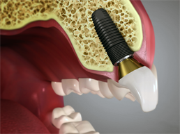 Dental Implants Dental Implants Rancho Mirage, Palm Desert, Palm Spring, Coachella Valley, Cathedral City, La Quinta, Desert Hot Springs, Yucca Valley, Indian Wells