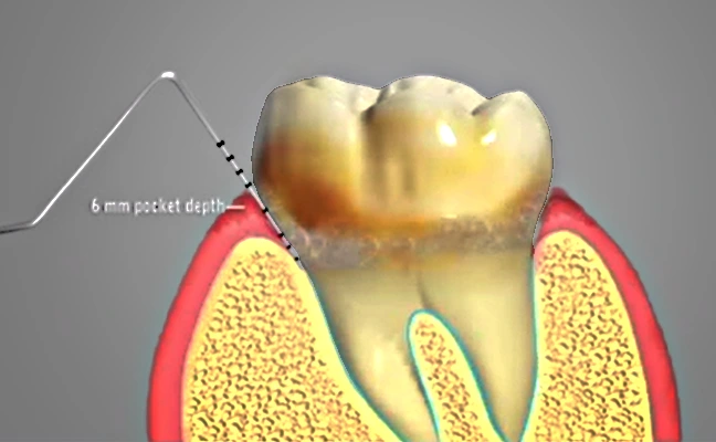 Dental Prophylaxis in Rancho Mirage