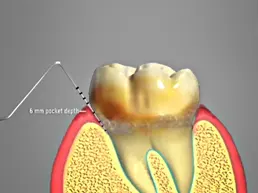 Dental Prophylaxis Dental Prophylaxis Rancho Mirage, Palm Desert, Palm Spring, Coachella Valley, Cathedral City, La Quinta, Desert Hot Springs, Yucca Valley, Indian Wells