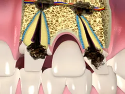 Endodontic Surgery Endodontic Surgery