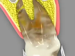 Extractions Emergency Extractions Emergency