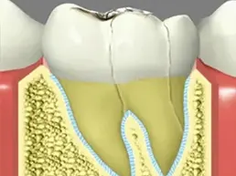 Fractured Tooth Fractured Tooth
