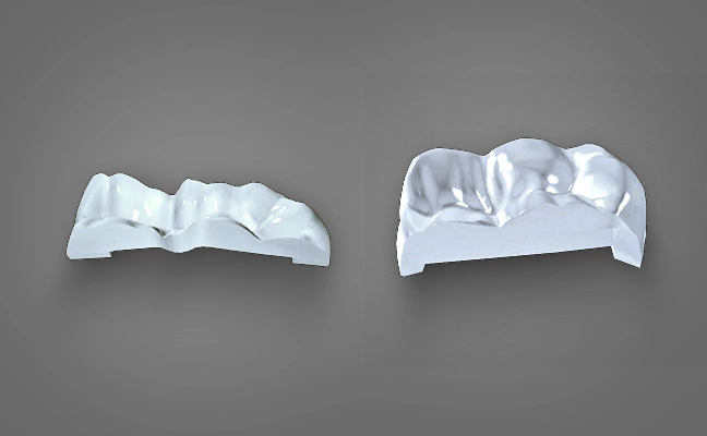 Porcelain Inlays and Onlays