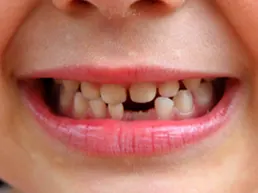 Missing Tooth Missing Tooth