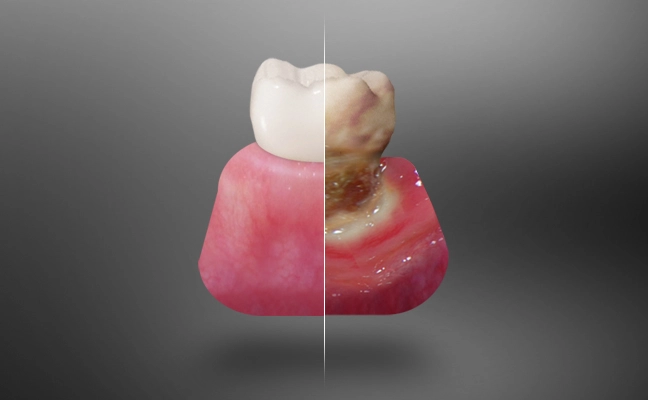 Periodontal Care Rancho Mirage, Palm Desert, Palm Spring, Coachella Valley, Cathedral City, La Quinta, Desert Hot Springs, Yucca Valley, Indian Wells