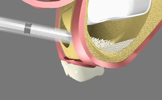 Sinus Graft Rancho Mirage, Palm Desert, Palm Spring, Coachella Valley, Cathedral City, La Quinta, Desert Hot Springs, Yucca Valley, Indian Wells