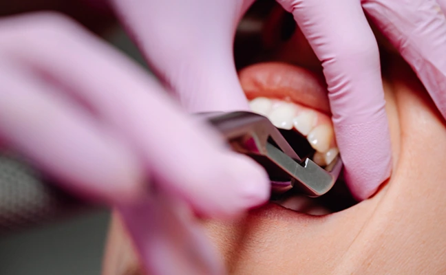 Tooth Extractions Tooth Extractions