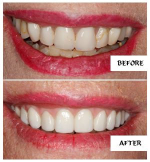 Dental Implants Case 21